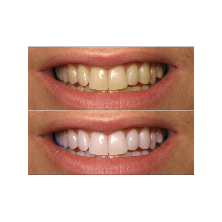 Bandes blanchissantes 3D White